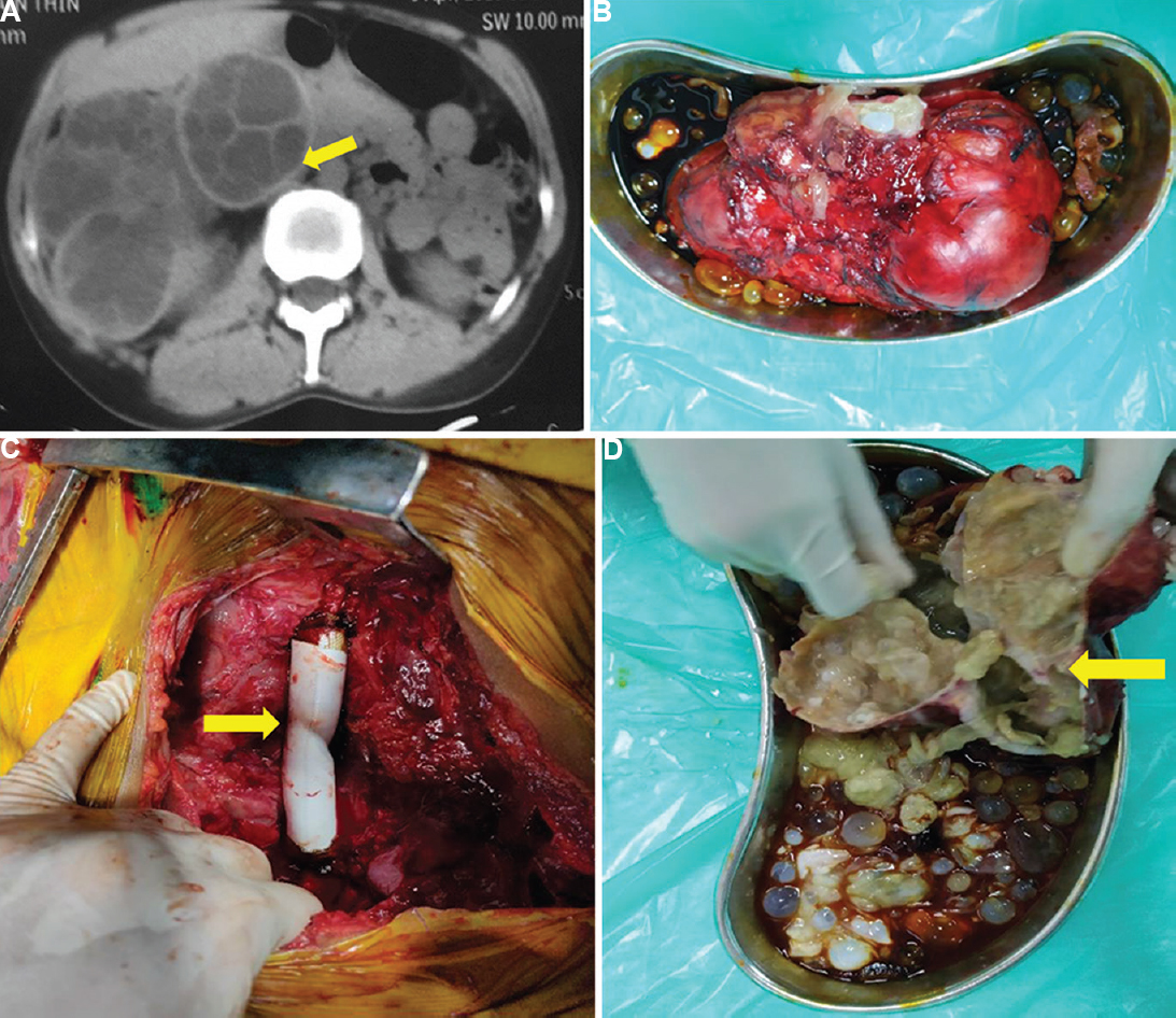 (A) Computed tomography abdomen showing right renal hydatid cyst involving the inferior vena cava (arrow). (B) Excised specimen showing a large right renal hydatid cyst. (C) The inferior vena cava after reconstruction with polytetrafluoroethylene graft (arrow). (D) Specimen cut open to show the involved inferior vena cava wall (arrow) and daughter cysts (yellow arrow).